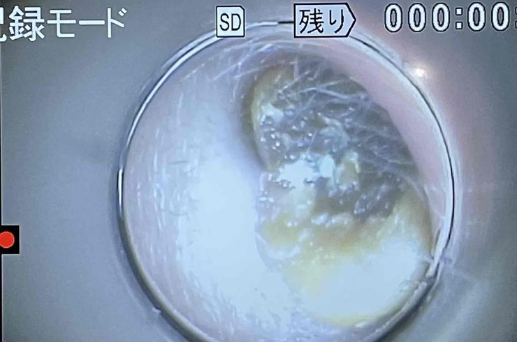 耳垢栓塞